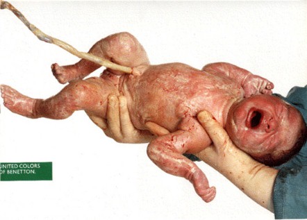 Campanha da Benetton de 1991, com a imagem de uma menina recém-nascida. O anúncio pretendia ser uma homenagem à vida, mas foi banida em inúmeros países
